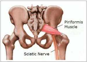 Sciatic Pain and Piriformis Syndrome 