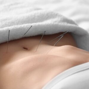 Photo of acupuncture for fertility. Needles in a woman's belly.