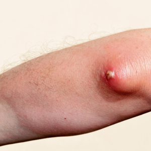 image of bursitis on the elbow