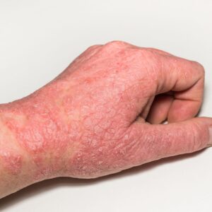 conditions like eczema are made worse by inflammatory foods