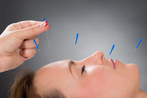 depicts woman getting acupuncture for allergies