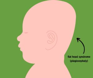 baby with flat head syndrome